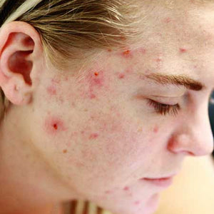 CYSTIC PIMPLE 101: HOME REMEDY AND PREVENTION