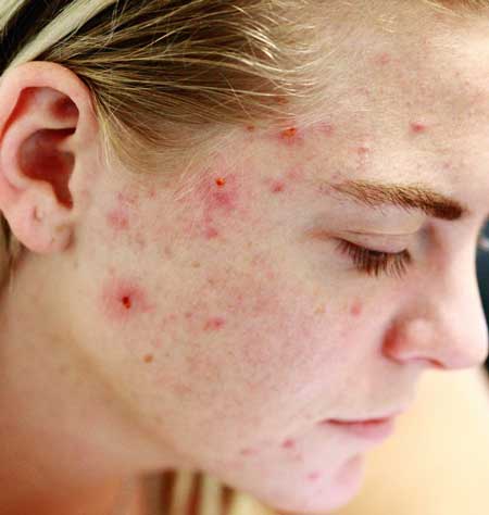 CYSTIC PIMPLE 101: HOME REMEDY AND PREVENTION